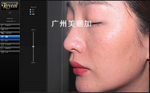 广州美丽加,reveal皮肤检测仪,测试仪,图像分析系统,红血丝,棕色斑,交叉偏振光,操作界面