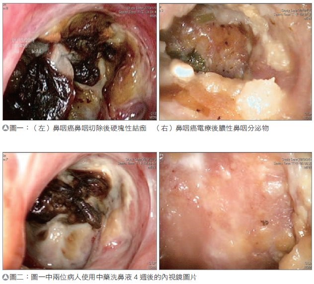 鼻咽癌放射线治疗后的鼻腔保健