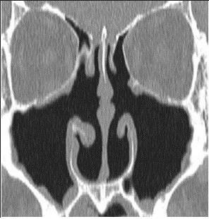 空鼻症患者计算机断层扫瞄（ＣＴ）