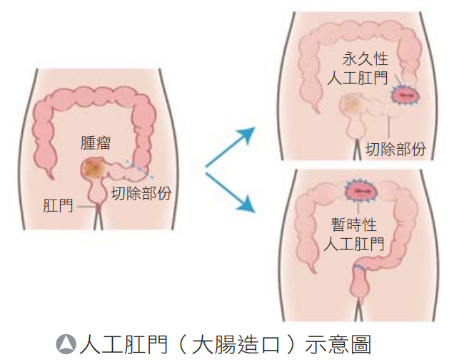 台湾长庚医院医师介绍人工肛门造口 台湾长庚医院医师介绍人工肛门造口