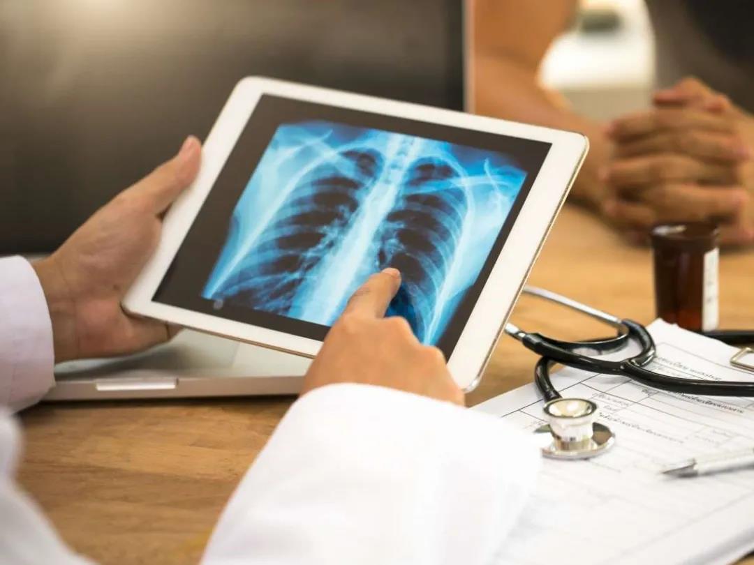 肺癌早期症状 肺癌早期症状