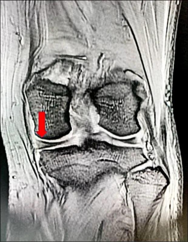 核磁共振检查显示，内侧半月板破裂（箭头处）