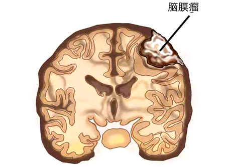 BNCT文献 | 硼中子俘获疗法临床应用综述