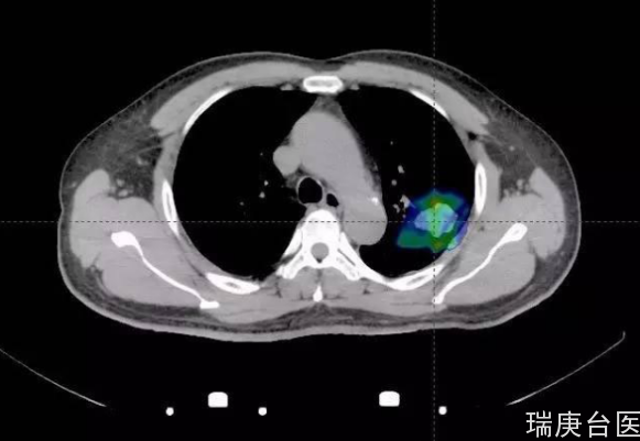 肺癌案例 | 質子治療優于手術可治愈