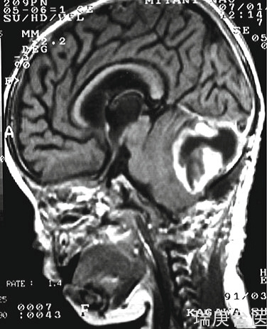 BNCT案例 | 幼兒小腦3級星形細胞瘤