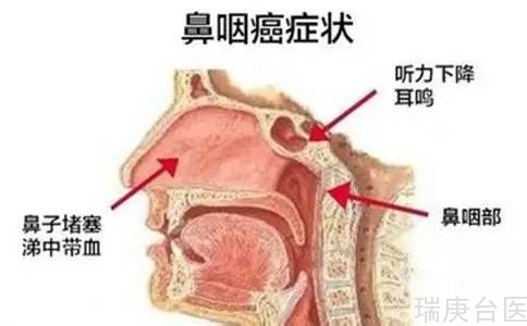 复发鼻咽癌 | 质子治疗有明显优势