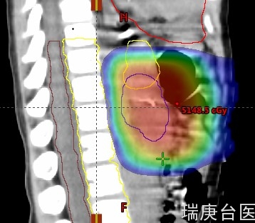 台湾长庚医院 | 质子放射治疗治疗儿童实体癌