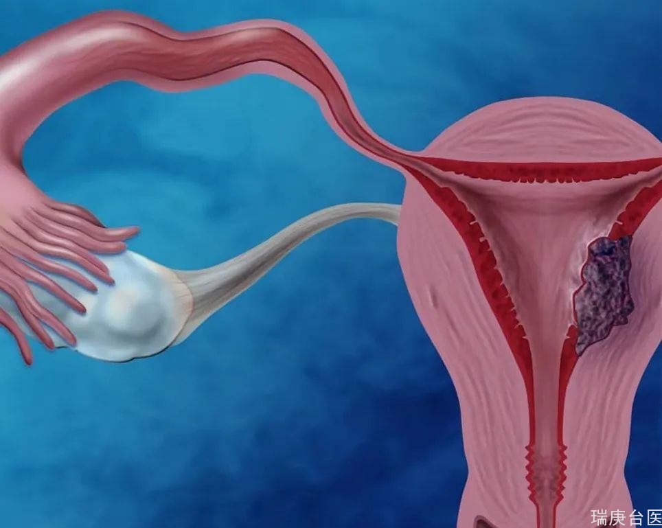 检查出子宫内膜病变，该拿掉子宫吗？