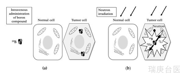 BNCT发展史 | 恶性肿瘤案例分享