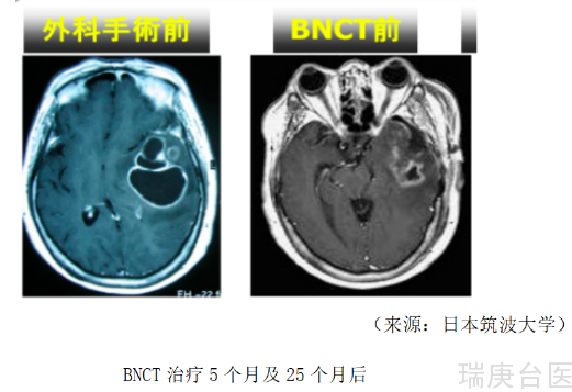 BNCT发展史 | 恶性肿瘤案例分享