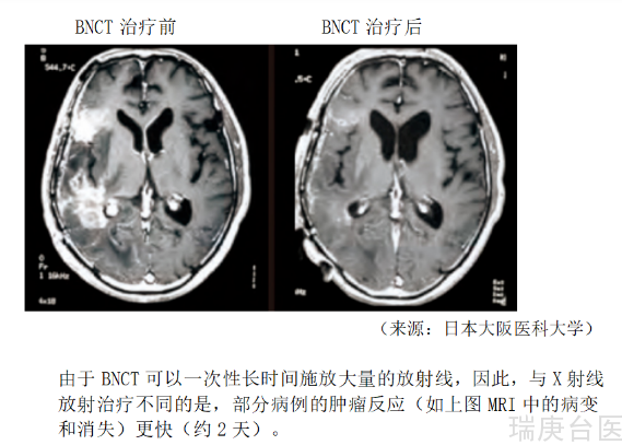 BNCT发展史 | 恶性肿瘤案例分享