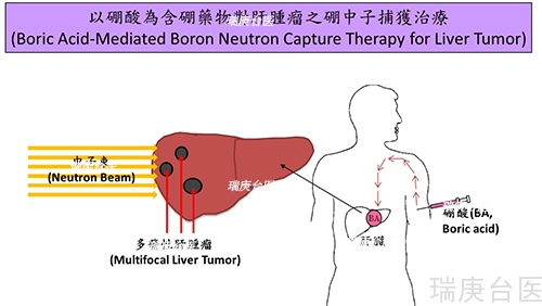 台湾硼中子捕获治疗 | 百发百中消灭肝癌细胞