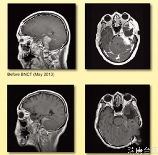 BNCT | 台湾BNCT中心投入癌症治疗成果佳