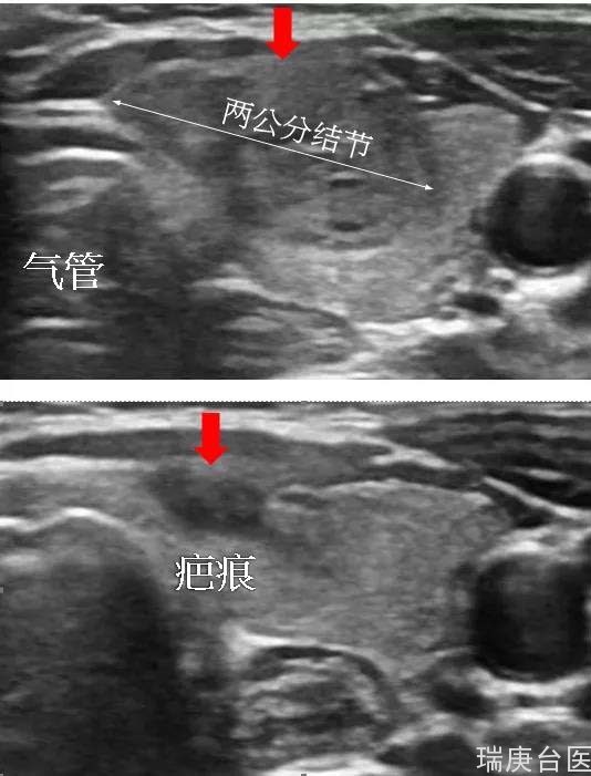 【医学新知】甲状腺结节无痕治疗：射频消融