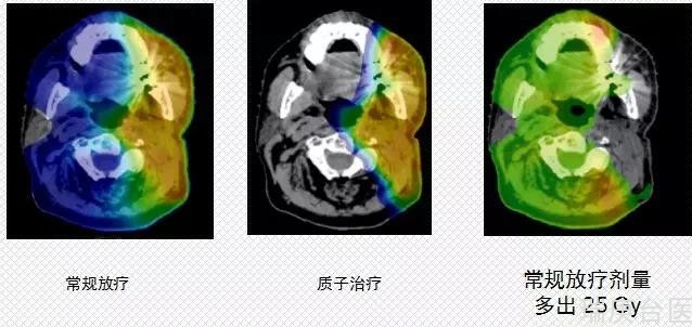 台湾长庚医院 | 头颈癌患者更适合做质子治疗吗？