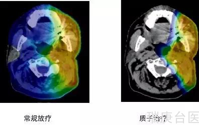 台湾长庚医院 | 头颈癌患者更适合做质子治疗吗？