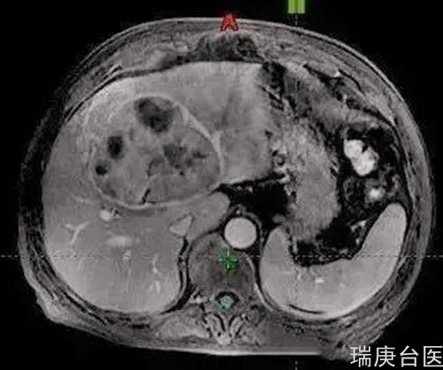 质子治疗 | 肝癌患者治疗2月肿瘤缩小明显