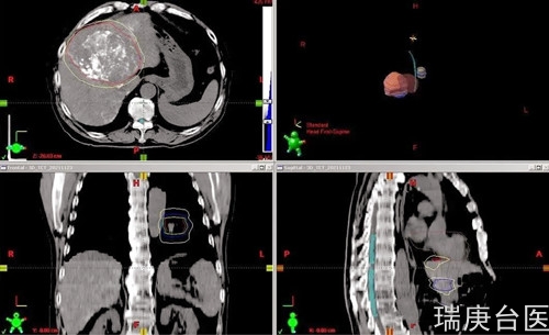 质子治疗 | 肝癌患者治疗2月肿瘤缩小明显