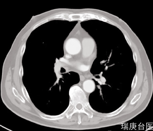 质子治疗 | 肝癌患者治疗2月肿瘤缩小明显