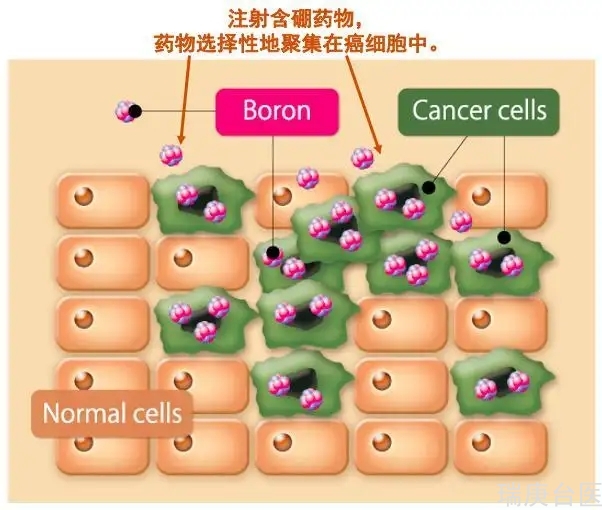 BNCT | 硼中子俘获疗法对肿瘤复发的探究