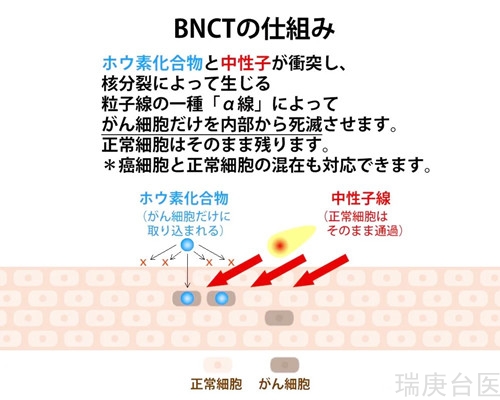 BNCT | 恶性脑肿瘤治疗案例