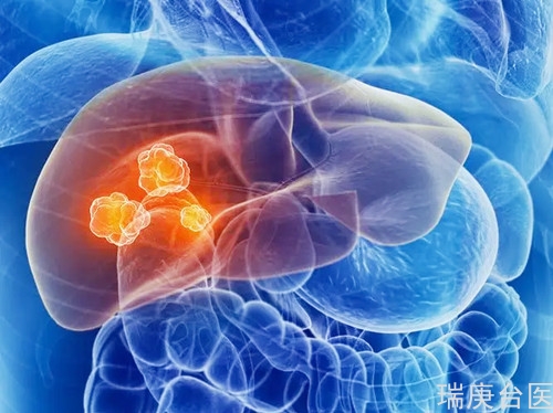 臨床研究 | BNCT對肝轉移癌具有良好的治療