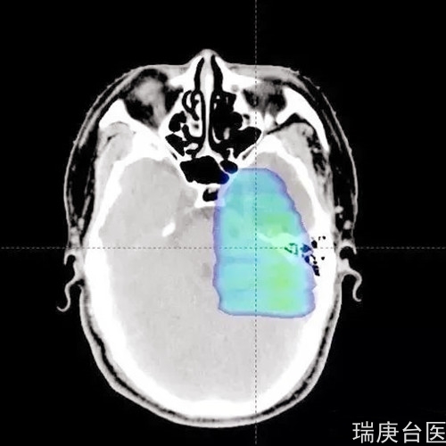 案例分享 | 血管周细胞瘤复发，质子治疗肿瘤较治疗前明显缩小