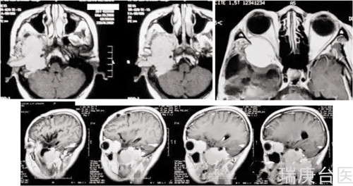 WHOⅢ級腦膜瘤 | 質子治療腫瘤縮小、壞死明顯