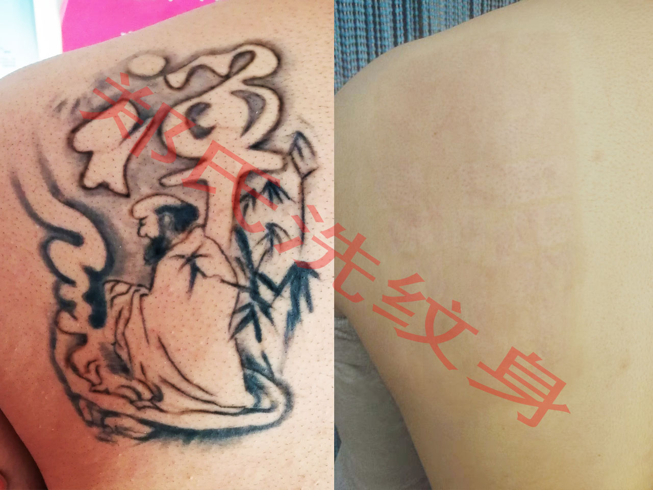 广州洗纹身