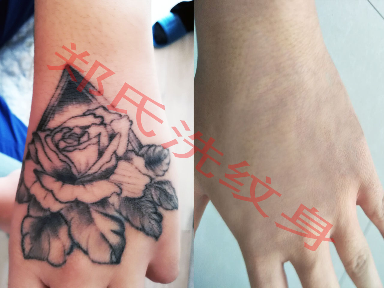 上海洗纹身