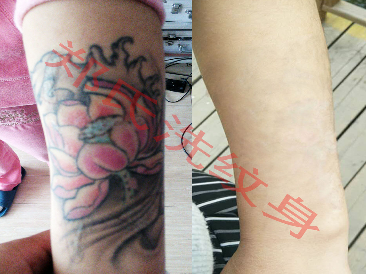 青岛洗纹身